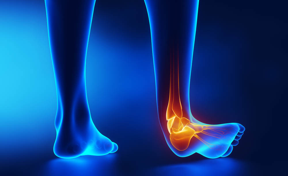 Distorsione Caviglia Gonfia Dopo 2 Mesi Distorsione Caviglia: Cos'è? Qual'è il trattamento? | Physio One